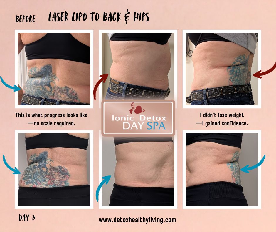 before and after laser lipo day 1 and day 3