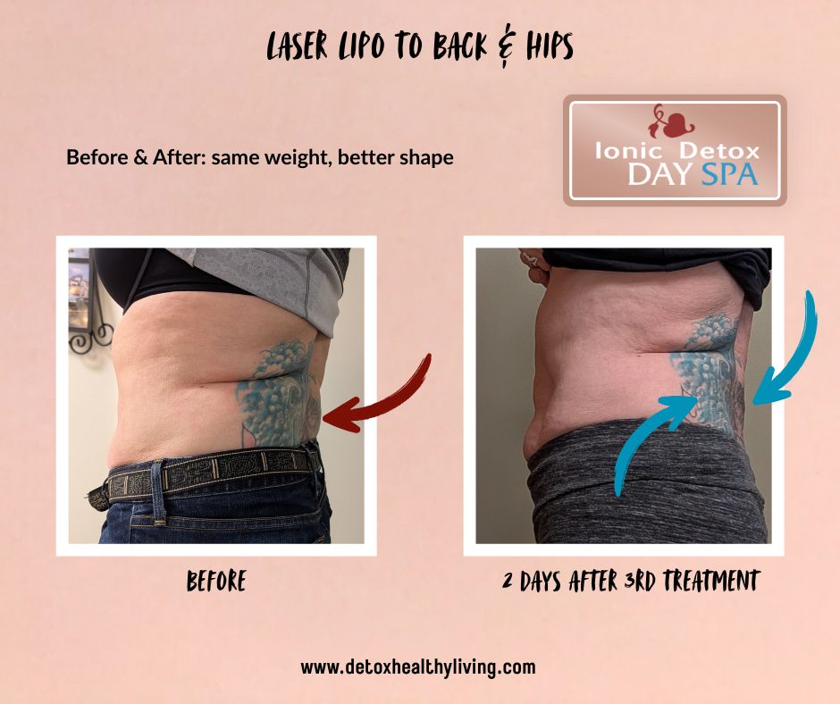 customers before and after laser lipo